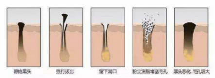 XNUO心诺黑头仪，用科学的方法祛除黑头