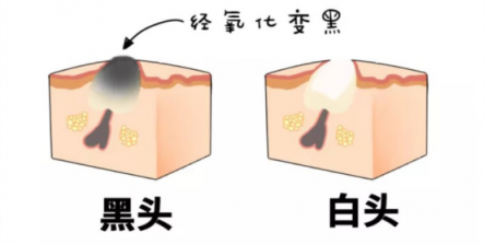 黑头仪有用吗？实力派去黑头就选它！