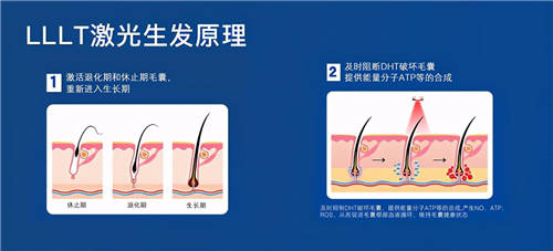 HairPro激光生发仪，效果堪比植发