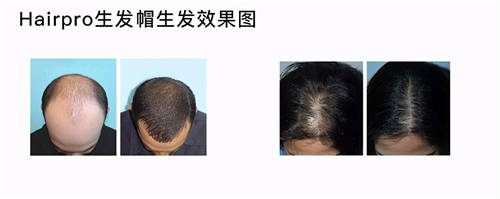 HairPro激光生发仪，效果堪比植发