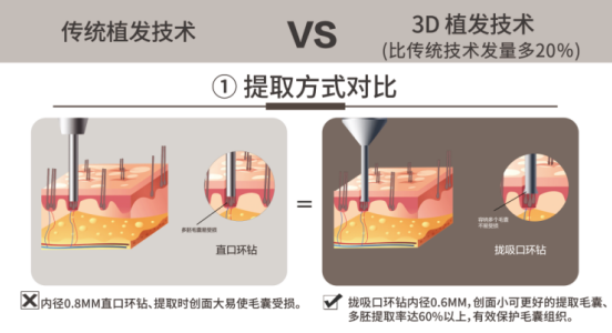 厦门新生植发：脱发人数超2.5亿，双十二消费报告植发数据爆增