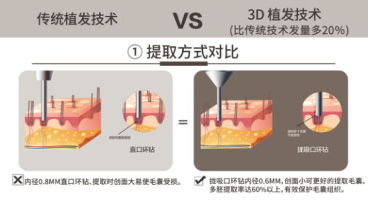 女性植发消费崛起，武汉新生植发3D植发高性价比受欢迎