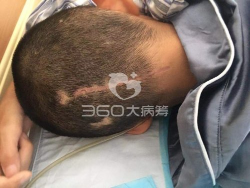 11岁男孩患头部恶性肿瘤 父亲通过360大病筹求助：救救孩子