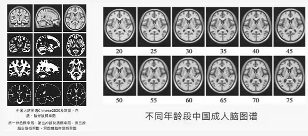 三代人攻坚中国人专属脑图谱，破解阿尔茨海默病密码