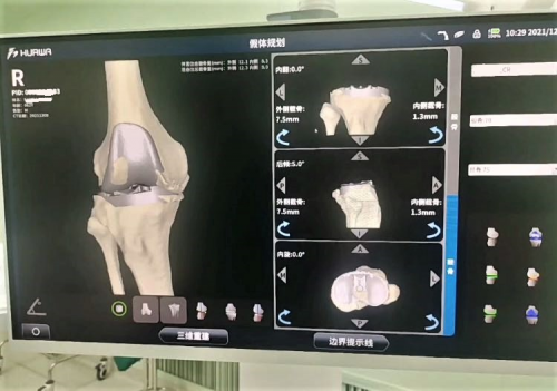HURWA机器人辅助CR-TKA术在内蒙成功开展：医生如同音乐指挥家