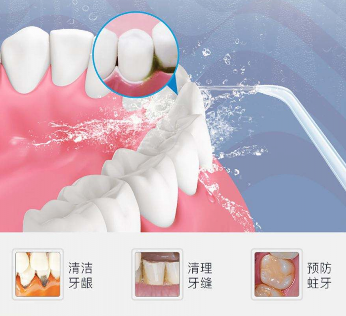 预防牙结石 XWAVES小蛮腰SE保卫口腔健康