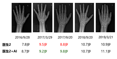 AI骨龄随访研究成果亮相中国儿科学术大会